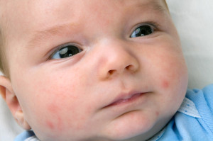 acnee-neonatala-bebelusi
