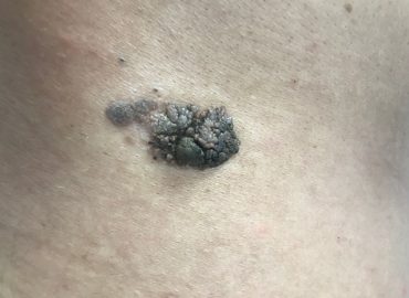 Keratoza seboreică - cauze, simptome și tratament