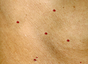 Ce sunt alunițele roșii (angioamele cherry) și de ce apar